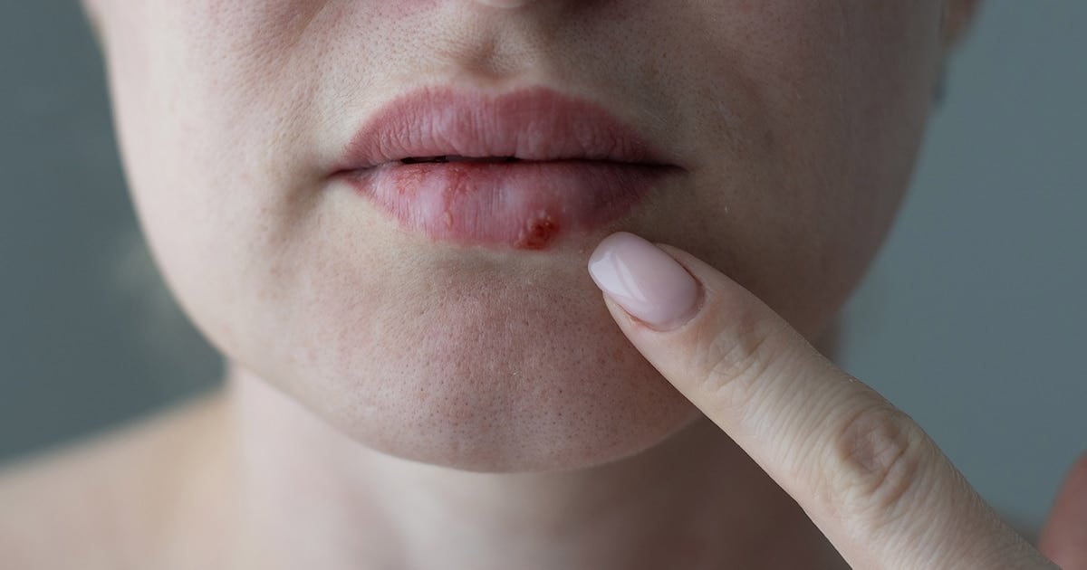 Un antiviral oral que cambia el panorama del herpes resistente: la FDA aprobó el pritelivir tras casi 30 años sin avances